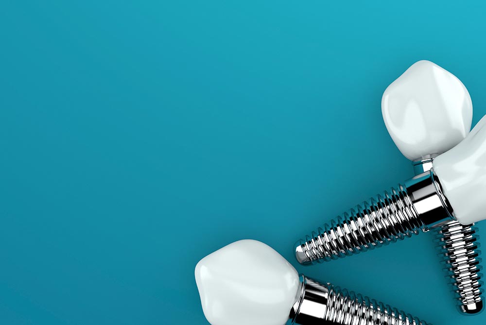 Implantate Zahnarzt